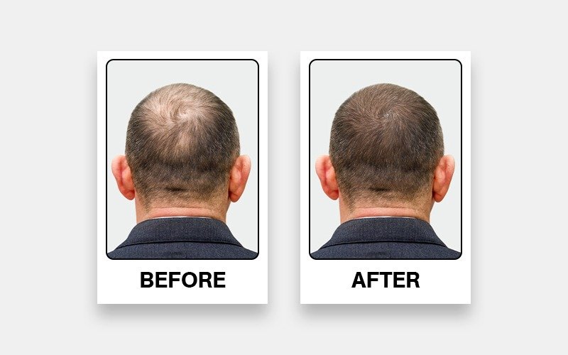 Hair Transplant in Dombivli – Get Permanent Results